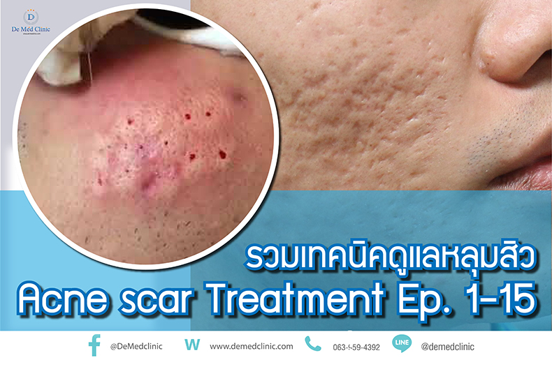 รวมเทคนิคดูแลหลุมสิว Acne scar Treatment Ep. 1-15