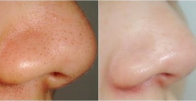 Klear Nose Cream ครีมดูแลสิวเสี้ยน สิวอุดตันที่จมูก  ครีมดูแลสิวเสี้ยน ลดสิวหัวดำ ลอกสิวเสี้ยน กระชับรูขุมขน ทำความสะอาดรูขุมขน 10 g