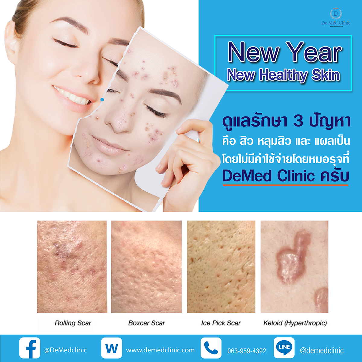 New Year New Healthy Skin ดูแลรักษา 3 ปัญหา คือ สิว หลุมสิว และ แผลเป็น โดยไม่มีค่าใช้จ่ายโดยหมอรุจที่ DeMed Clinic ครับ