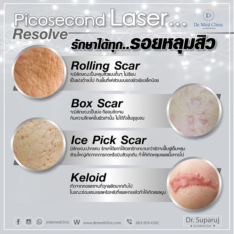 Picosecond Laser...ดูแลรักษาทุกปัญหาแผลเป็น หลุมสิว แผลคีลอยด์ และแผลรักษายาก ปรึกษาหมอรุจได้ครับ แผลต่างๆ ที่เกิดปัญหากวนใจ มีหลายแบบอาทิเช่น