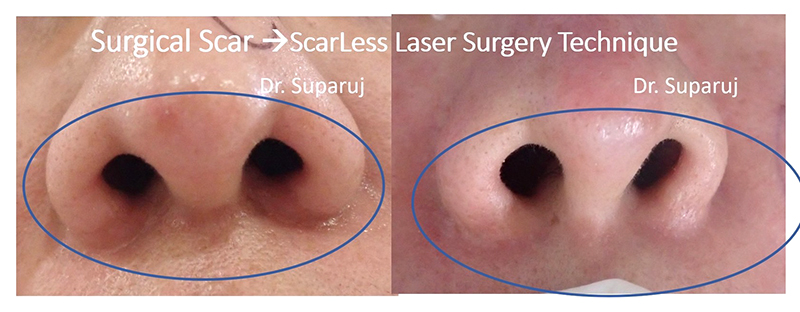 ดูแลแผลผ่าตัด แผลเป็นนูนด้วย ScarLess Laser Surgery Technique