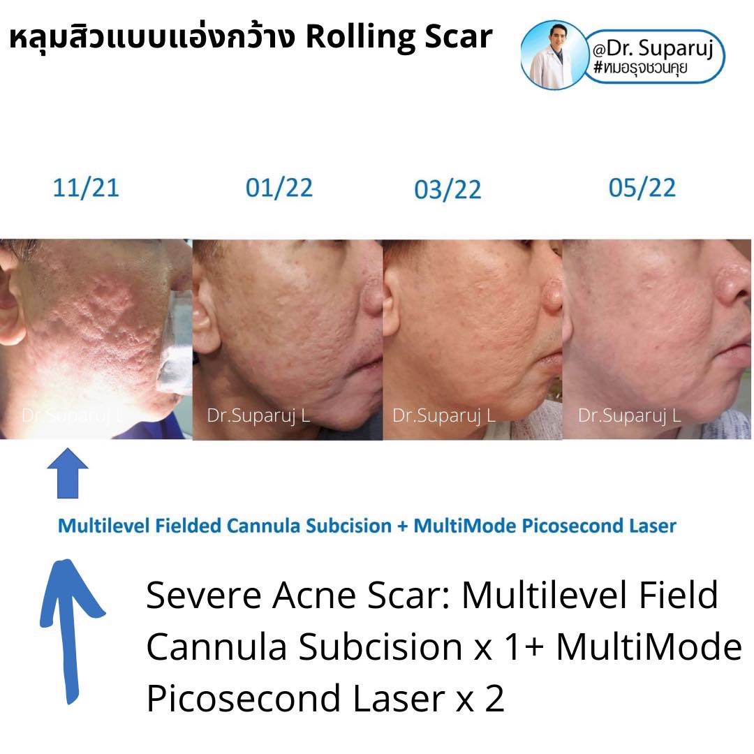 เลเซอร์ Picosecond Laser ช่วยดูแลหลุมสิวดีขึ้นต่อเนื่องถึงเดือนที่ 6 หลังการรักษาครั้งสุดท้าย  