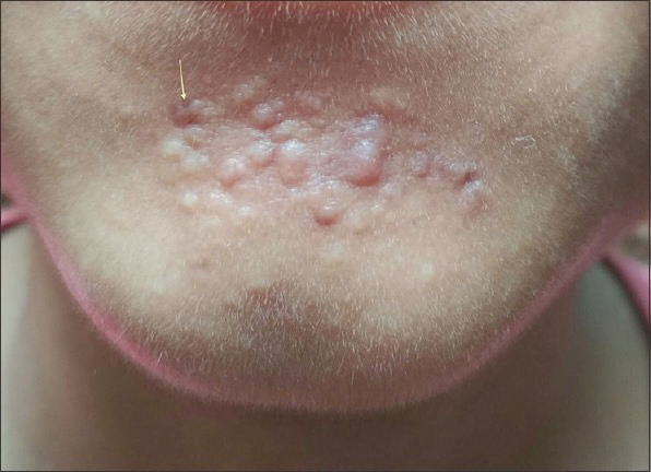 แผลเป็นจากสิวแบบนูน Papular acne scar คืออะไร ? ดูแลได้อย่างไร ?