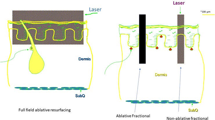 เลเซอร์กรอผิวทั้งชั้น Fully Ablative Laser Resurfacing &เทคนิคเลเซอร์กรอผิวเฉพาะจุด Deep Focus Ablative Laser