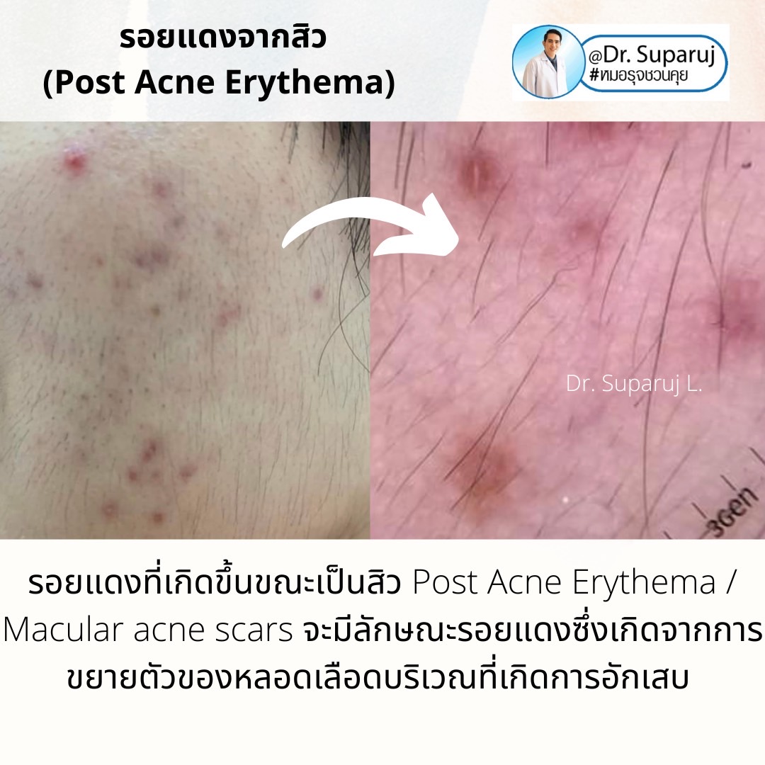 รอยแดงจากสิว (Post Acne Erythema) และ แผลเป็นหลุมสิวรอยแดงระยะแรก (Macular Acne Scar) เกิดจากอะไรและดูแลได้อย่างไร? (Update 2022)