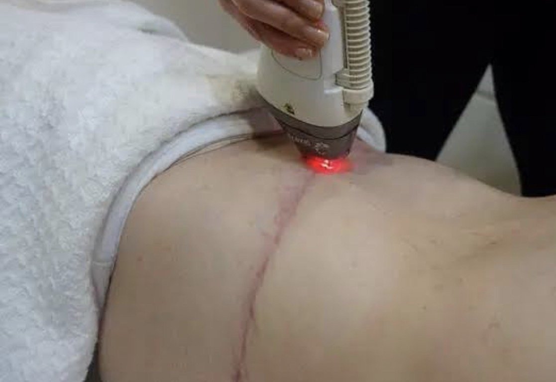 เทคนิคดูแลรักษาแผลเป็นนูนคีลอยด์จากผ่าตัดคลอด Cesarean section scar treatment and prevention