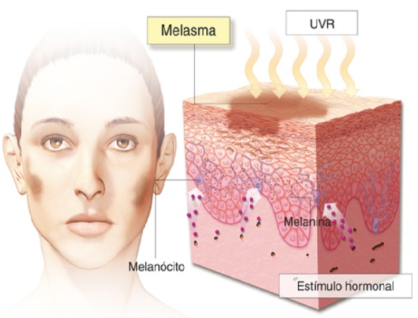 ดูแลฝ้าด้วยเทคนิคเลเซอร์ดึงเม็ดสีแบบแบ่งส่วน Fractional Laser for Melasma Treatment