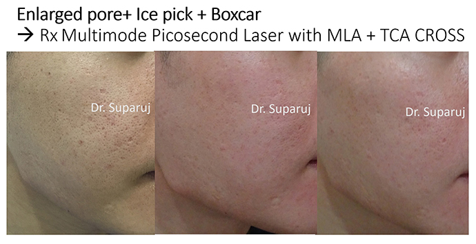 รูขุมขนกว้าง Enlarged Facial Pore ดูแลได้อย่างไร Part II?