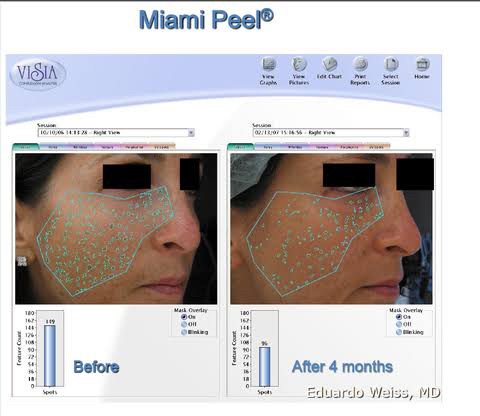 Miami Peel ® Treatment ดูแลฝ้ากระ จุดด่างดำริ้วรอย