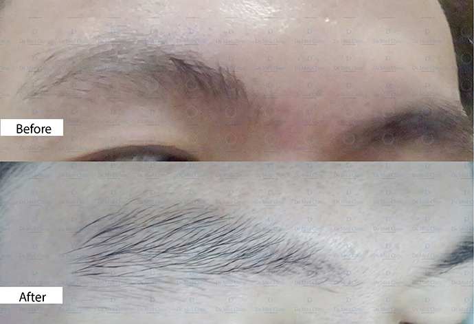 Perfect Eyebrows Program by De Med Clinic คิ้ว หนา เข้ม ดำ สวยได้รูป โดยไม่ต้องผ่าตัดปลูกคิ้ว ไม่เจ็บ ด้วยเทคนิคพิเศษเฉพาะของ De Med Clinic เท่านั้น