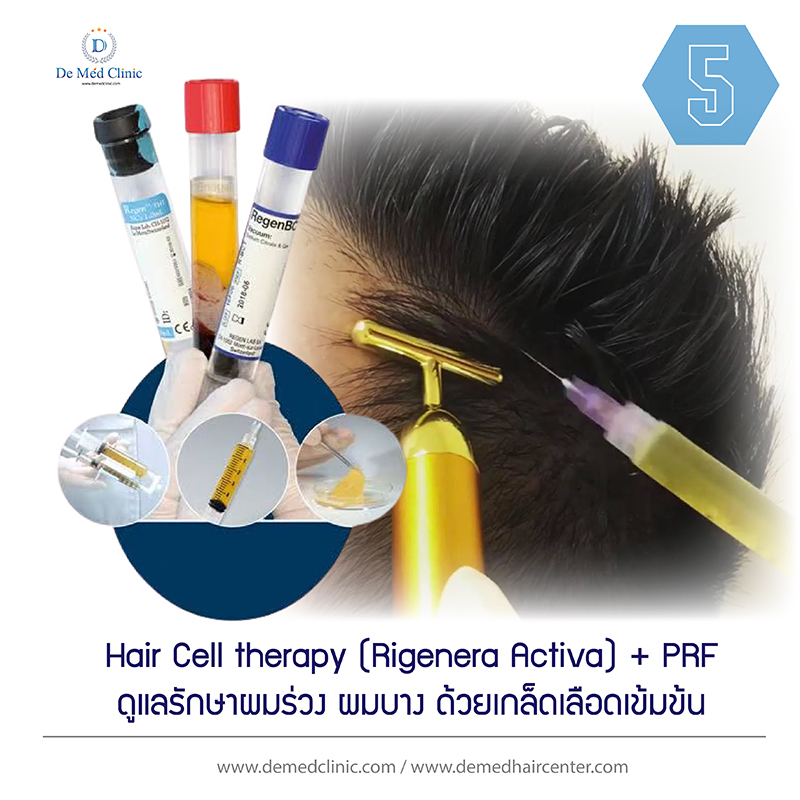 5. Hair Cell therapy (Rigenera Activa) + PRF ดูแลรักษาผมร่วง ผมบาง ด้วยเกล็ดเลือดเข้มข้น
