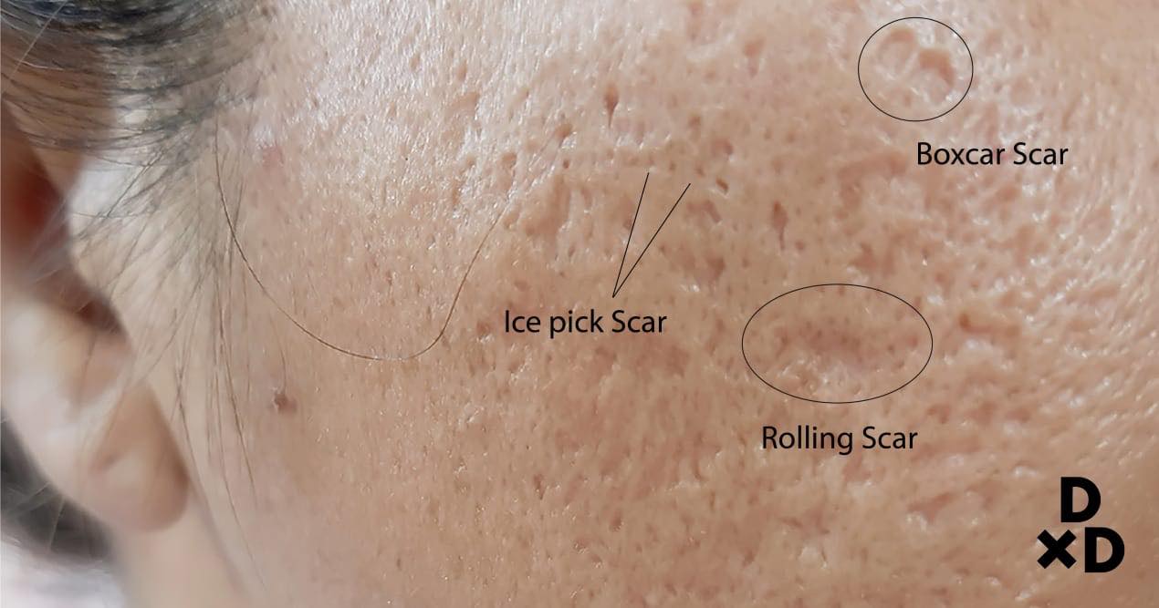 รอยแผลเป็นจากสิว Acne Scar มีกี่ชนิด รักษาได้อย่างไรบ้าง ?