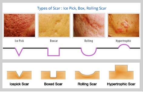 รอยแผลเป็นจากสิว Acne Scar มีกี่ชนิด รักษาได้อย่างไรบ้าง ?