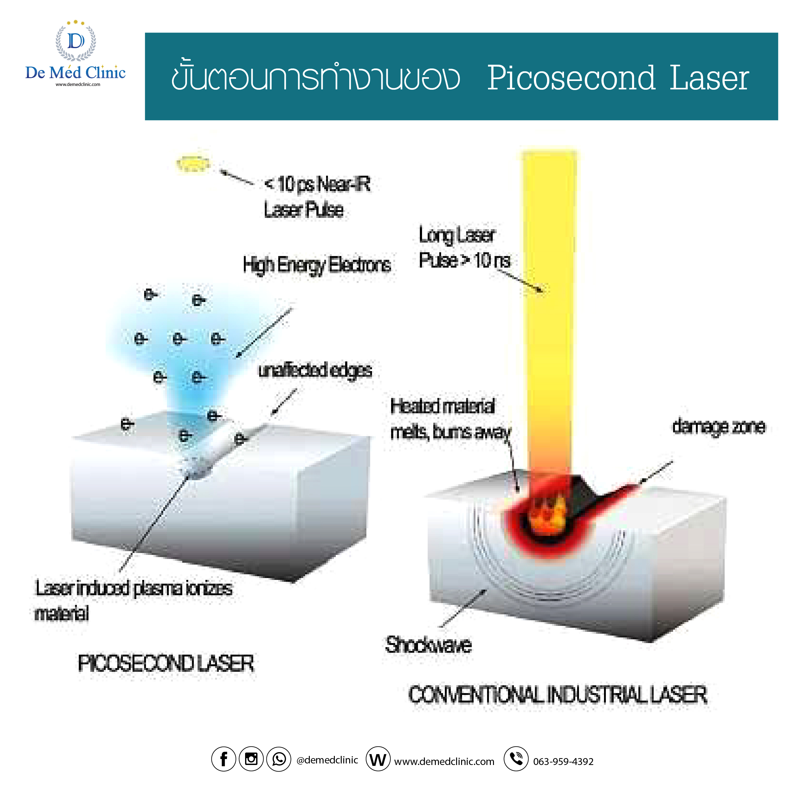 Picosecond Laser เทคโนโลยีใหม่ล่าสุด ช่วยจัดการปัญหา ฝ้า กระ ริ้วรอย จุดด่างดำบนใบหน้าได้อย่างมีประสิทธิภาพ