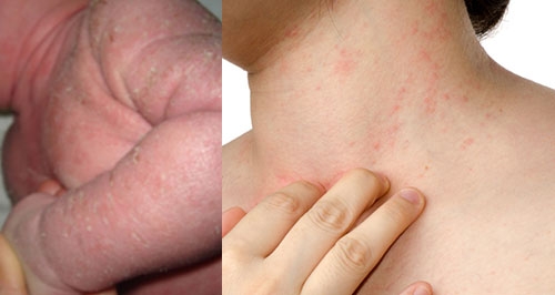 โรคผื่นภูมิแพ้ผิวหนังในเด็ก Atopic Dermatitis (AD) โดย ผู้ช่วยศาสตราจารย์นายแพทย์ เทอดพงศ์ เต็มภาคย์ 