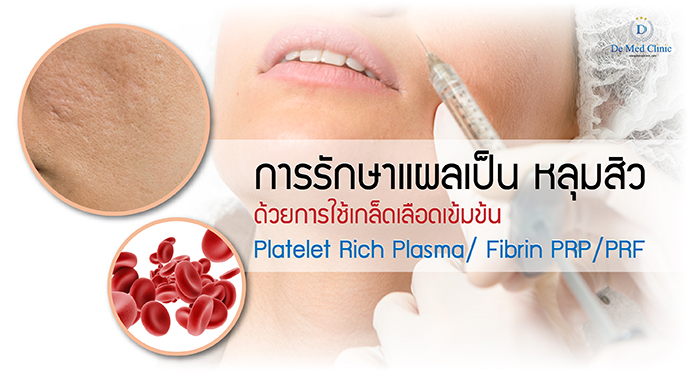 การรักษา แผลเป็น หลุมสิวด้วยการใช้เกล็ดเลือดเข้มข้น Platelet Rich Plasma/ Fibrin PRP/PRF 