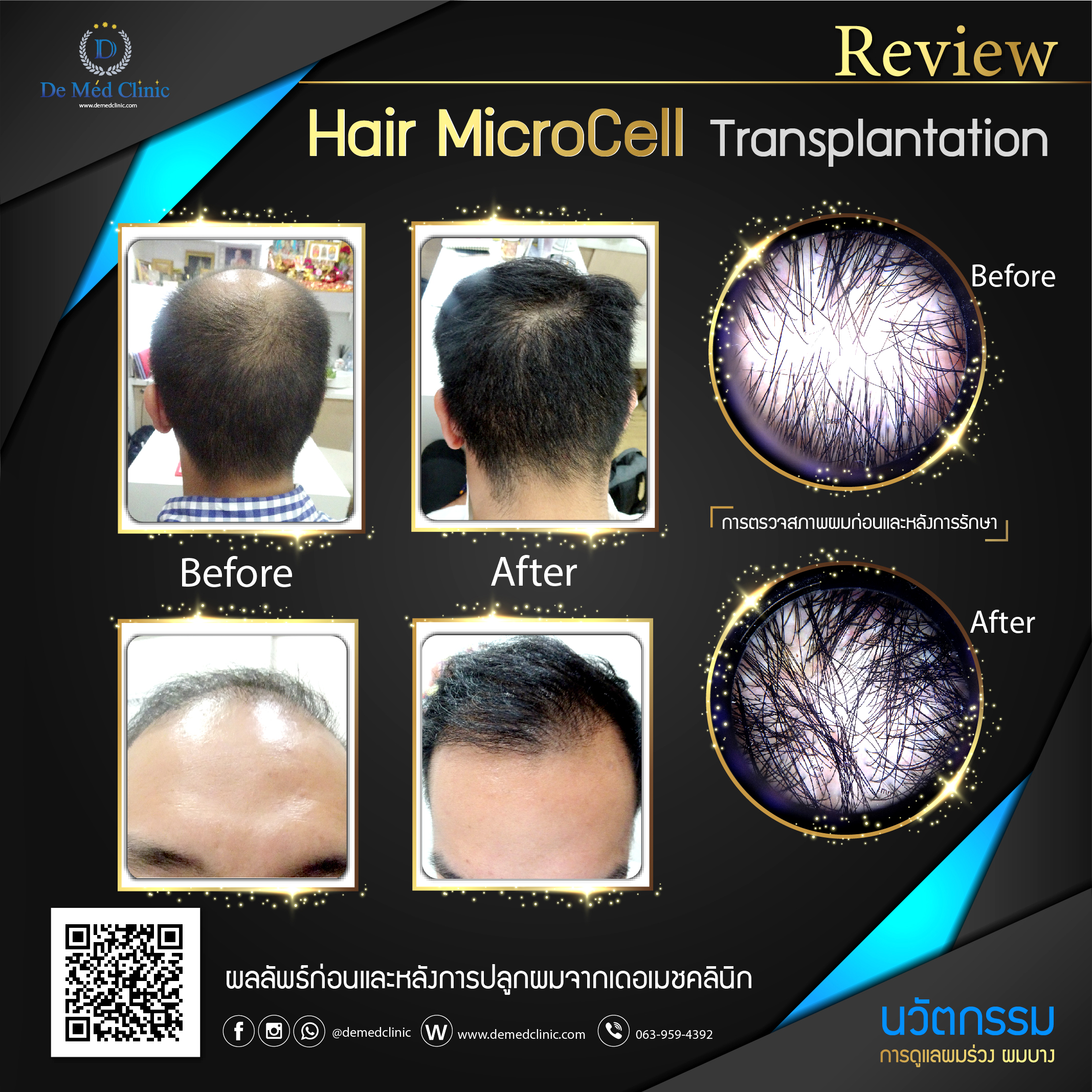  Hair MicroCell Transplantation (HMT)
