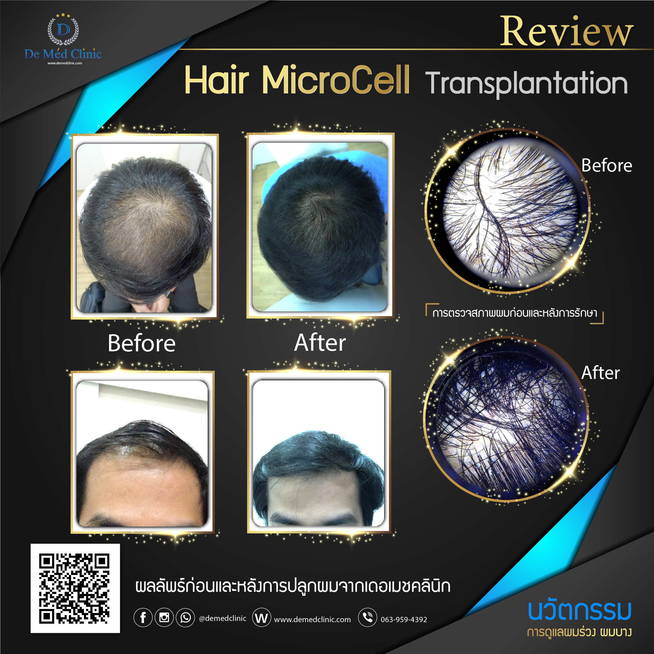  Hair MicroCell Transplantation (HMT)