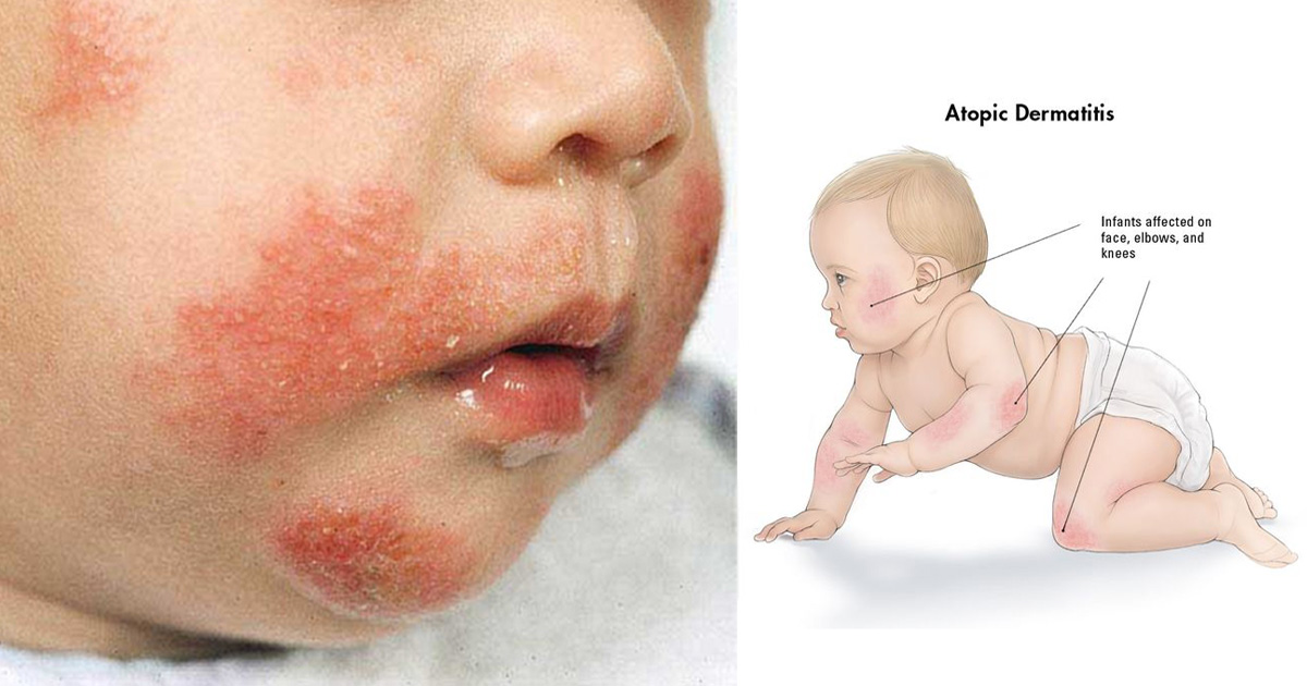 โรคผื่นภูมิแพ้ผิวหนังในเด็ก Atopic Dermatitis (AD)