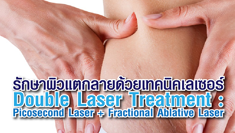 รักษาผิวแตกลายด้วยเทคนิคเลเซอร์ Double Laser Treatment : Picosecond Laser + Fractional Ablative Laser