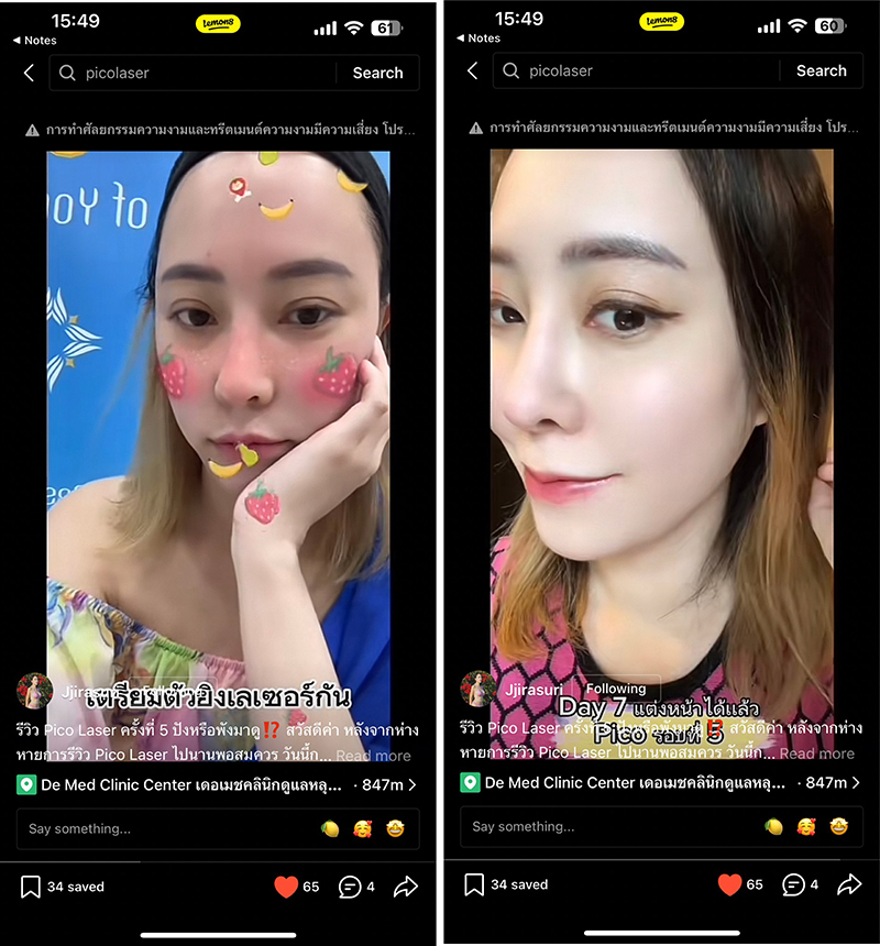 รีวิว Pico Laser รักษาหลุมสิวครั้งที่ 5 ปังหรือพังมาดู !? รีวิว Pico Laser รักษาหลุมสิวครั้งที่ 5 ปังหรือพังมาดู !?