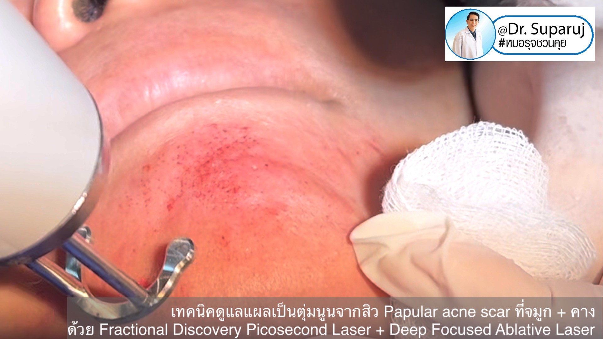 เทคนิคดูแลแผลเป็นตุ่มนูนจากสิว Papular acne scar ที่จมูก + คาง ด้วย Fractional Discovery Picosecond Laser + Deep Focused Ablative Laser