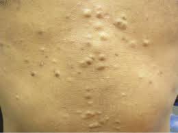 แนะนำเทคนิคดูแล ก้อนซีสต์จากท่อต่อมไขมัน Steatocystoma Multiplex (SM) ด้วย เข็มพลังงานคลื่นวิทยุ Insulated Radiofrequency RF Microneedle for Steatocystoma Multiplex Treatment แนะนำเทคนิคดูแล ก้อนซีสต์จากท่อต่อมไขมัน Steatocystoma Multiplex (SM) ด้วย เข็มพลังงานคลื่นวิทยุ Insulated Radiofrequency RF Microneedle for Steatocystoma Multiplex Treatment