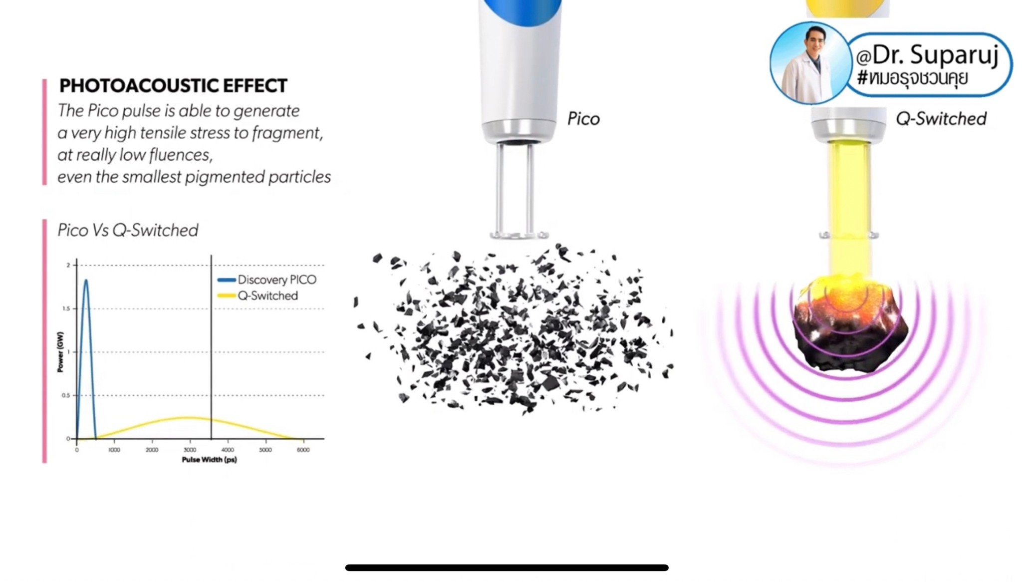 แนะนำเทคนิคดูแลริมฝีปากคล้ำ Lip Hyperpigmentation ริ้วรอย ริ้วรอยรอบริมฝีปาก: สาเหตุ การดูแล & เทคนิคเลเซอร์ MultiMode Discovery Picosecond Laser Lip Rejuvenation แนะนำเทคนิคดูแลริมฝีปากคล้ำ Lip Hyperpigmentation ริ้วรอย ริ้วรอยรอบริมฝีปาก: สาเหตุ การดูแล & เทคนิคเลเซอร์ MultiMode Discovery Picosecond Laser Lip Rejuvenation