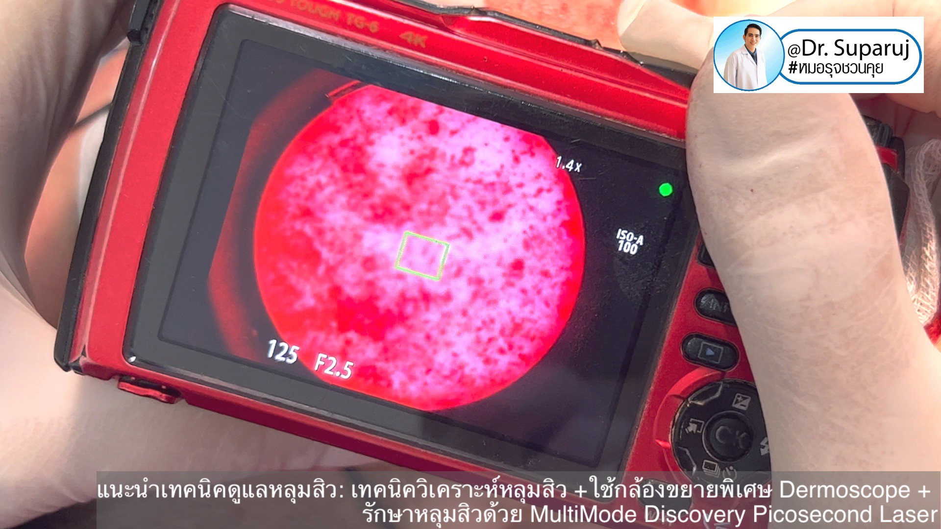 แนะนำเทคนิคดูแลหลุมสิว: เทคนิควิเคราะห์หลุมสิว +ใช้กล้องขยายพิเศษ Dermoscope + รักษาหลุมสิวด้วย MultiMode Discovery Picosecond Laser + Exosome Therapy แนะนำเทคนิคดูแลหลุมสิว: เทคนิควิเคราะห์หลุมสิว +ใช้กล้องขยายพิเศษ Dermoscope + รักษาหลุมสิวด้วย MultiMode Discovery Picosecond Laser + Exosome Therapy