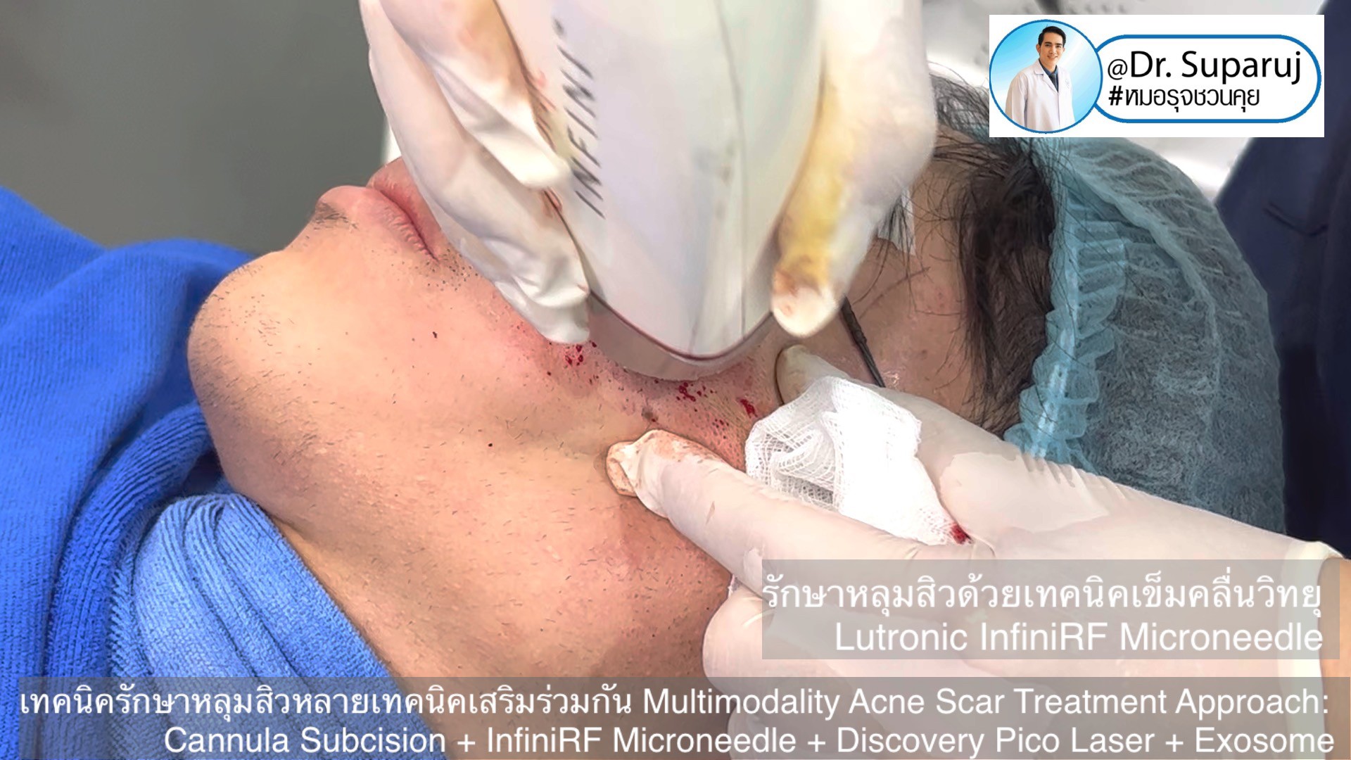 เทคนิครักษาหลุมสิวด้วยหลายเทคนิคเสริมร่วมกัน Multimodality Acne Scar Treatment Approach: Cannula Subcision + InfiniRF Microneedle + Discovery Pico Laser + Exosome เทคนิครักษาหลุมสิวด้วยหลายเทคนิคเสริมร่วมกัน Multimodality Acne Scar Treatment Approach: Cannula Subcision + InfiniRF Microneedle + Discovery Pico Laser + Exosome