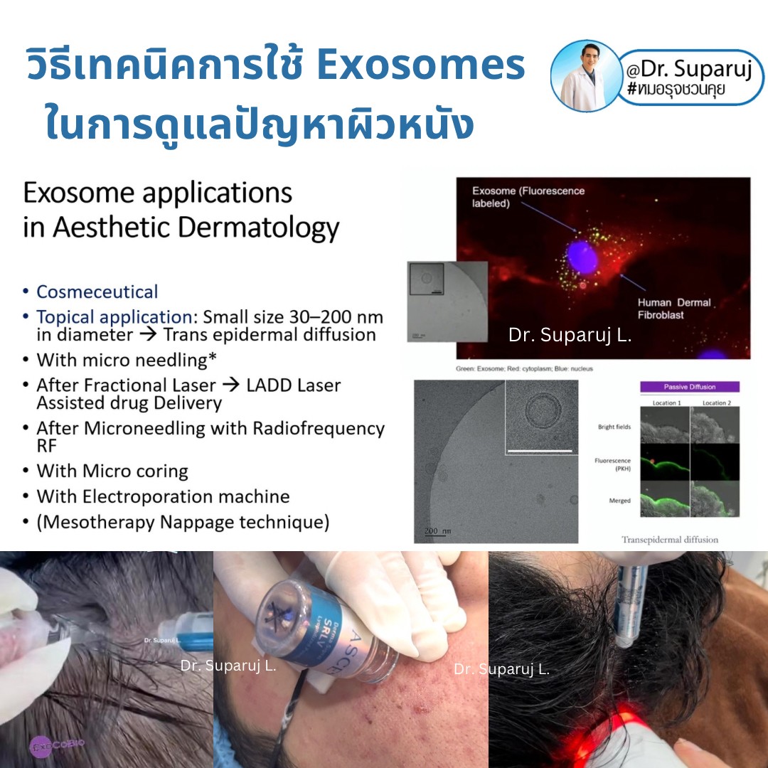 Exosomes มีบทบาทและกลไกในการดูแลฝ้า หรือไม่ & กลไกลเป็นอย่างไร ? Exosomes มีบทบาทและกลไกในการดูแลฝ้า หรือไม่ & กลไกลเป็นอย่างไร ?