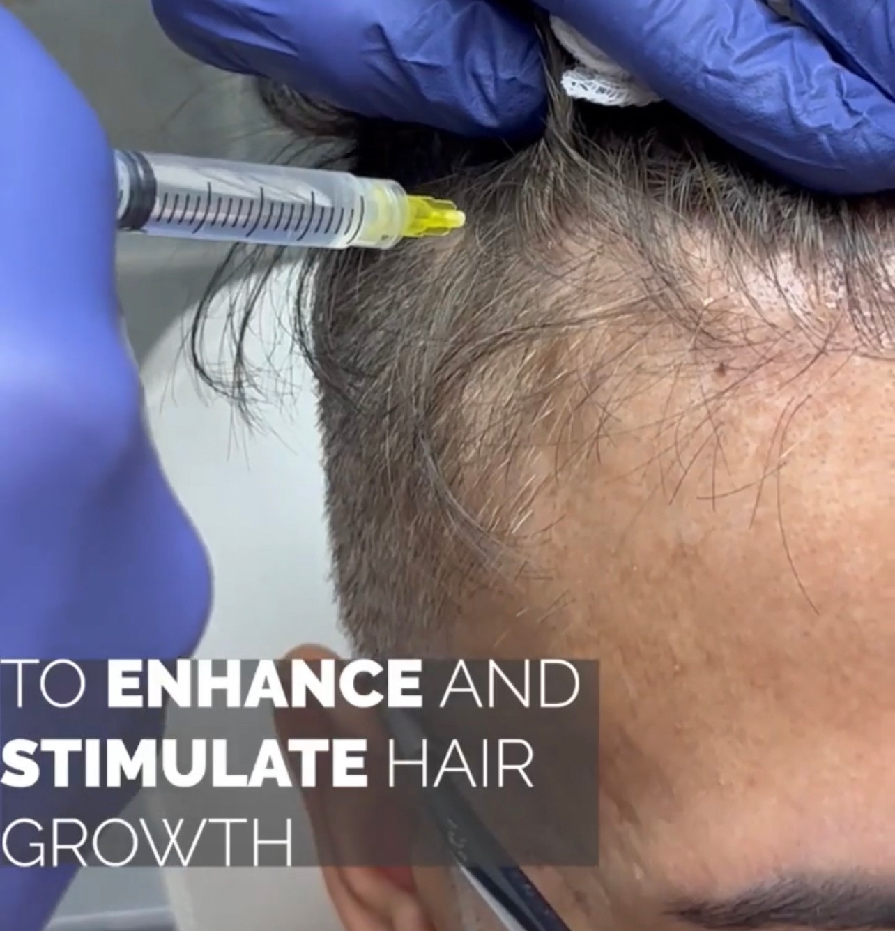 แนะนำเทคนิคดูแลปัญหาผมร่วงผมบาง: Exosome เอ็กโซโซม ช่วยดูแลผมร่วงผมบางได้อย่างไร? แนะนำเทคนิคดูแลปัญหาผมร่วงผมบาง: Exosome เอ็กโซโซม ช่วยดูแลผมร่วงผมบางได้อย่างไร?