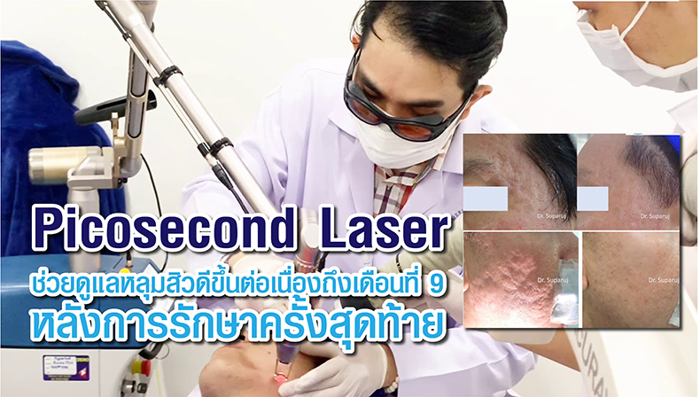 Picosecond Laser ช่วยดูแลหลุมสิวดีขึ้นต่อเนื่องถึงเดือนที่ 9 หลังการรักษาครั้งสุดท้าย
