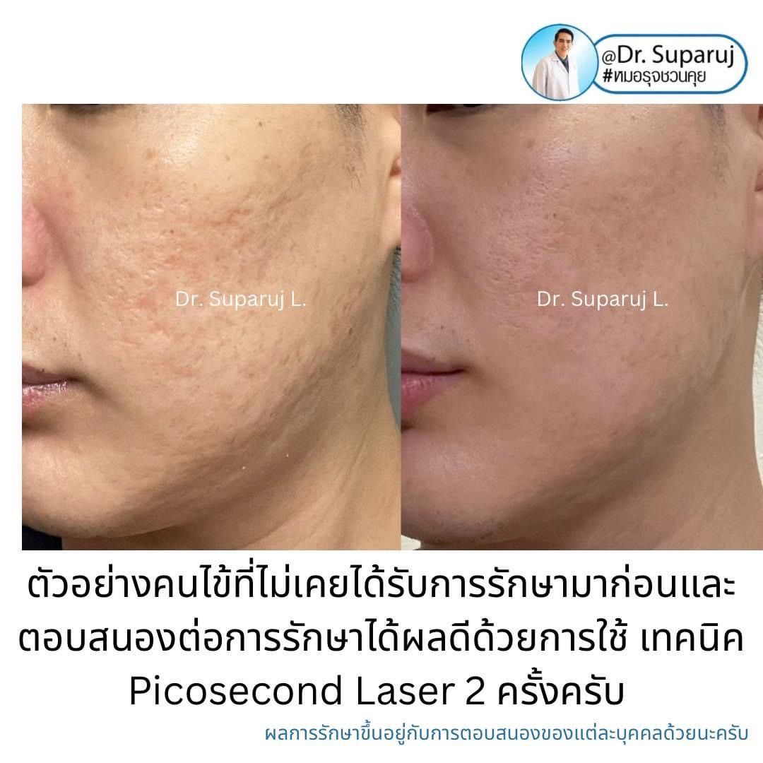 เป็นหลุมสิว แต่ยังไม่พร้อมรักษาหลุมสิว ทำอย่างไรดี? (+ เทคนิคการ เลือกใช้วิธีรักษาลุมสิวเบื้องต้นครับ) เป็นหลุมสิว แต่ยังไม่พร้อมรักษาหลุมสิว ทำอย่างไรดี? (+ เทคนิคการ เลือกใช้วิธีรักษาลุมสิวเบื้องต้นครับ)