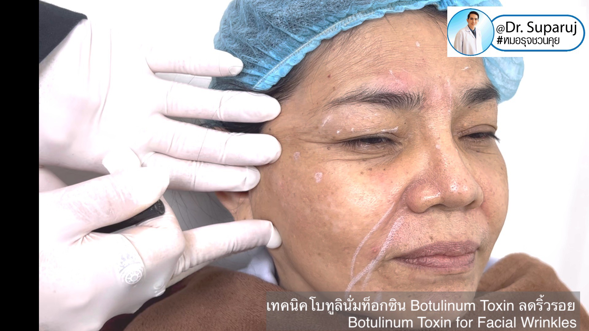 เทคนิคโบทูลินั่มท็อกซิน Botulinum Toxin ลดริ้วรอย Botulinum Toxin for Facial Wrinkles เทคนิคโบทูลินั่มท็อกซิน Botulinum Toxin ลดริ้วรอย Botulinum Toxin for Facial Wrinkles