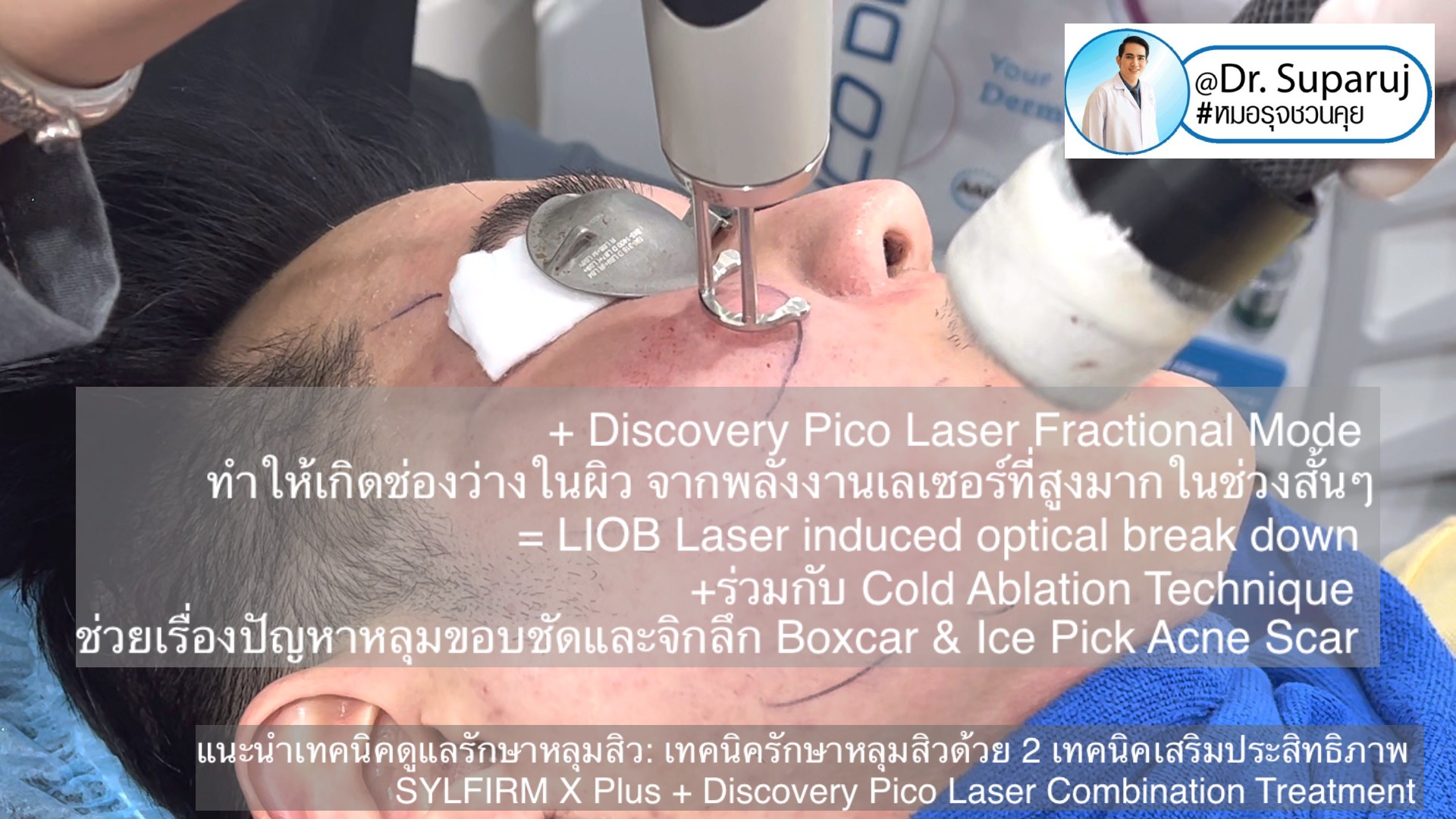 แนะนำเทคนิคดูแลรักษาหลุมสิว: เทคนิครักษาหลุมสิวด้วย 2 เทคนิคเสริมประสิทธิภาพ SYLFIRM X Plus + Discovery Pico Laser Combination Treatment แนะนำเทคนิคดูแลรักษาหลุมสิว: เทคนิครักษาหลุมสิวด้วย 2 เทคนิคเสริมประสิทธิภาพ SYLFIRM X Plus + Discovery Pico Laser Combination Treatment