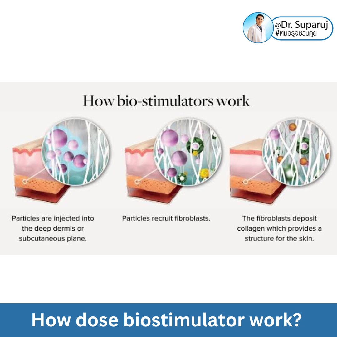 Update เทคนิคกระตุ้นการสร้างคอลลาเจนในผิวหนังลดเลือนริ้วรอย: Collagen Biostimulator Update เทคนิคกระตุ้นการสร้างคอลลาเจนในผิวหนังลดเลือนริ้วรอย: Collagen Biostimulator