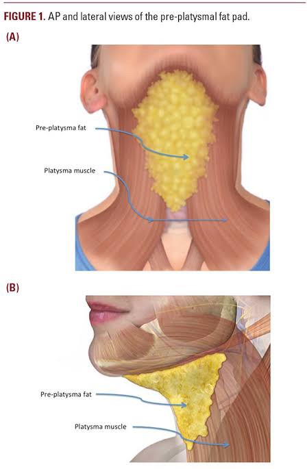 สาเหตุ & เทคนิคลดเหนียง ไขมันใต้คาง คาง 2 ชั้น Double Chin & Submental Fullness Treatment  สาเหตุ & เทคนิคลดเหนียง ไขมันใต้คาง คาง 2 ชั้น Double Chin & Submental Fullness Treatment