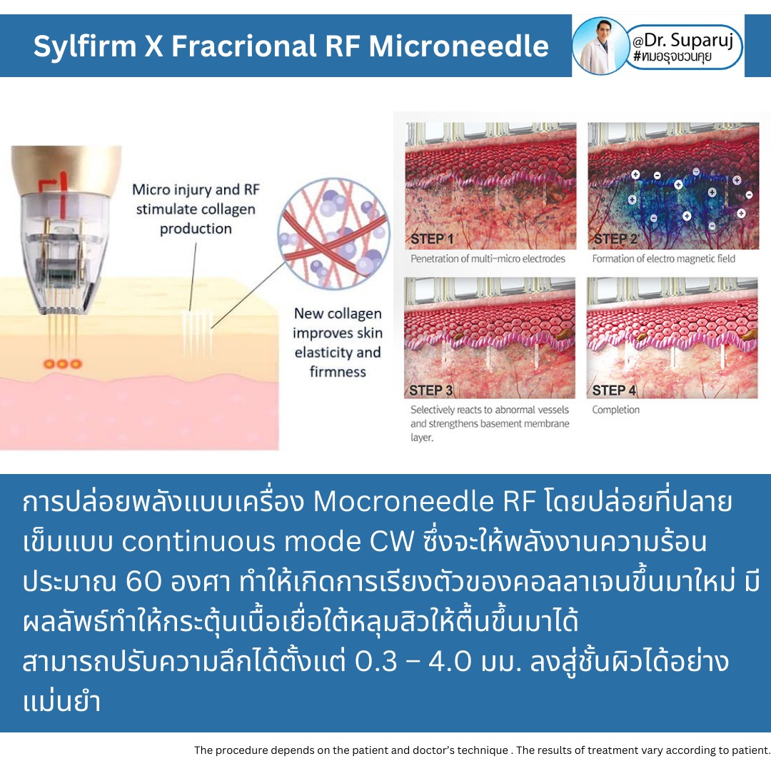 Update เทคนิคยกกระชับผิว หลุมสิว ดูแลปัญหาเม็ดสี ฝ้า+เส้นเลือด ด้วยนวัตกรรมคลื่นวิทยุแบบเข็ม Fractional microneedle Radiofrequency : SYLFIRM X Update เทคนิคยกกระชับผิว หลุมสิว ดูแลปัญหาเม็ดสี ฝ้า+เส้นเลือด ด้วยนวัตกรรมคลื่นวิทยุแบบเข็ม Fractional microneedle Radiofrequency : SYLFIRM X