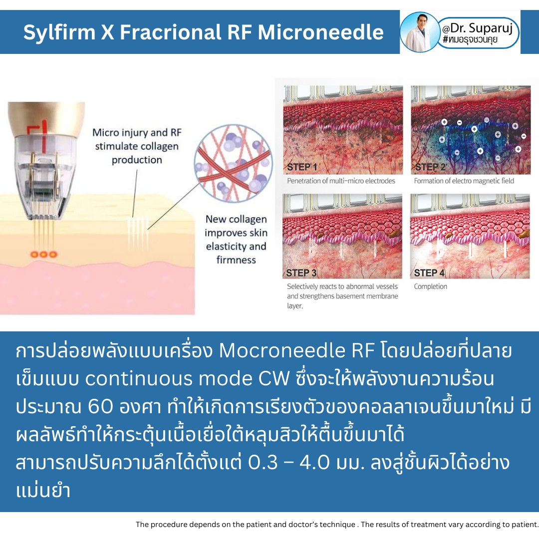 Update เทคนิคยกกระชับผิว หลุมสิว ดูแลปัญหาเม็ดสี ฝ้า+เส้นเลือด ด้วยนวัตกรรมคลื่นวิทยุแบบเข็ม Fractional microneedle Radiofrequency : SYLFIRM X