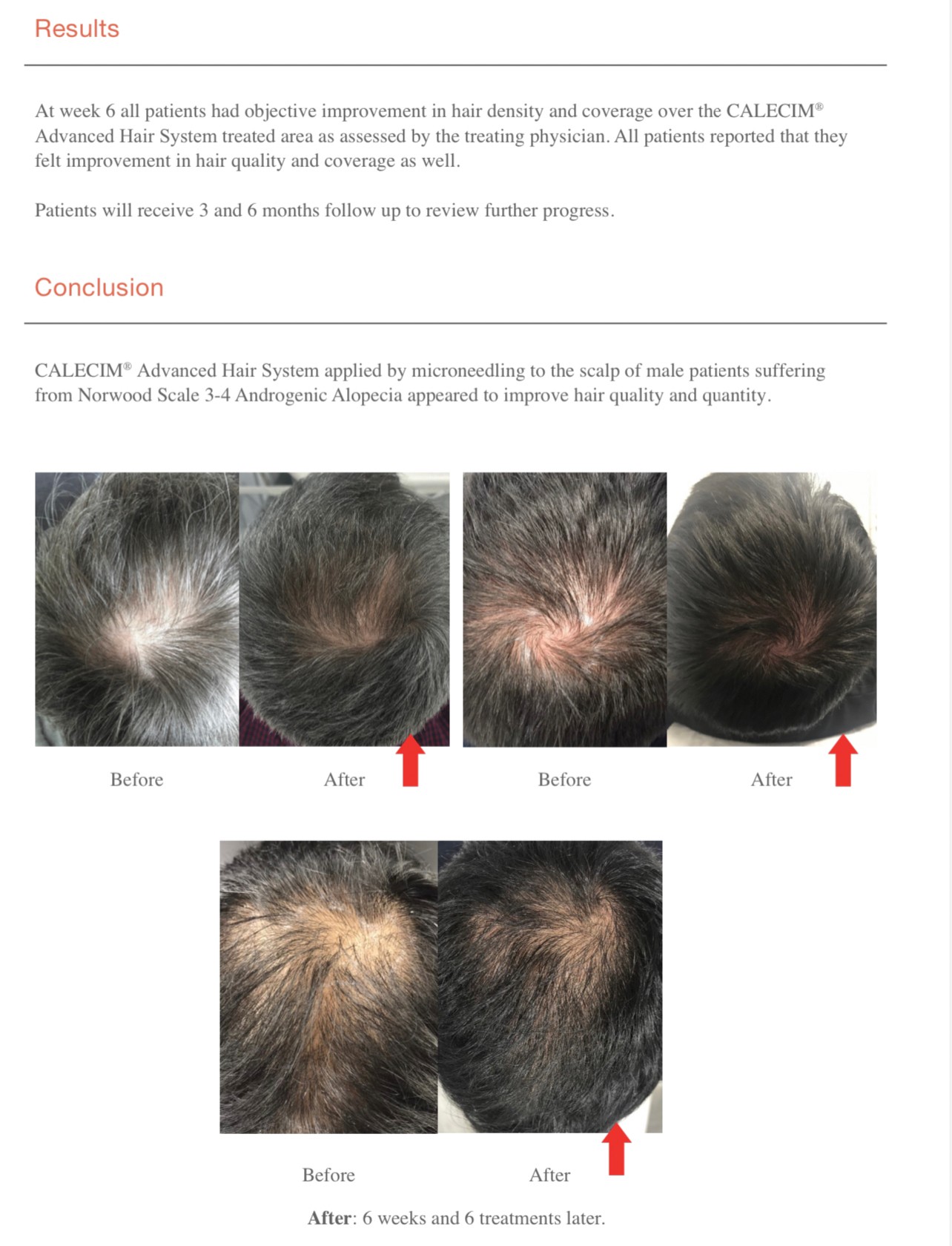 Update จากการประชุมแพทย์ผิวหนังระดับโลก WCD 2023: นวัตกรรมในการดูแลผมร่วงผมบางด้วยการใช้ Calecim Advanced Hair System Update จากการประชุมแพทย์ผิวหนังระดับโลก WCD 2023: นวัตกรรมในการดูแลผมร่วงผมบางด้วยการใช้ Calecim Advanced Hair System