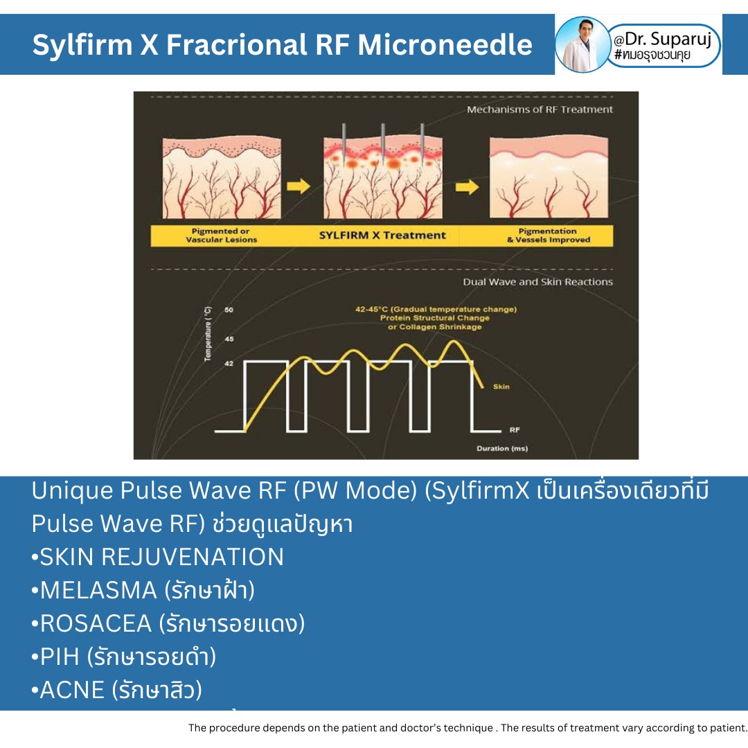 Update เทคนิคยกกระชับผิว หลุมสิว ดูแลปัญหาเม็ดสี ฝ้า+เส้นเลือด ด้วยนวัตกรรมคลื่นวิทยุแบบเข็ม Fractional microneedle Radiofrequency : SYLFIRM X Update เทคนิคยกกระชับผิว หลุมสิว ดูแลปัญหาเม็ดสี ฝ้า+เส้นเลือด ด้วยนวัตกรรมคลื่นวิทยุแบบเข็ม Fractional microneedle Radiofrequency : SYLFIRM X