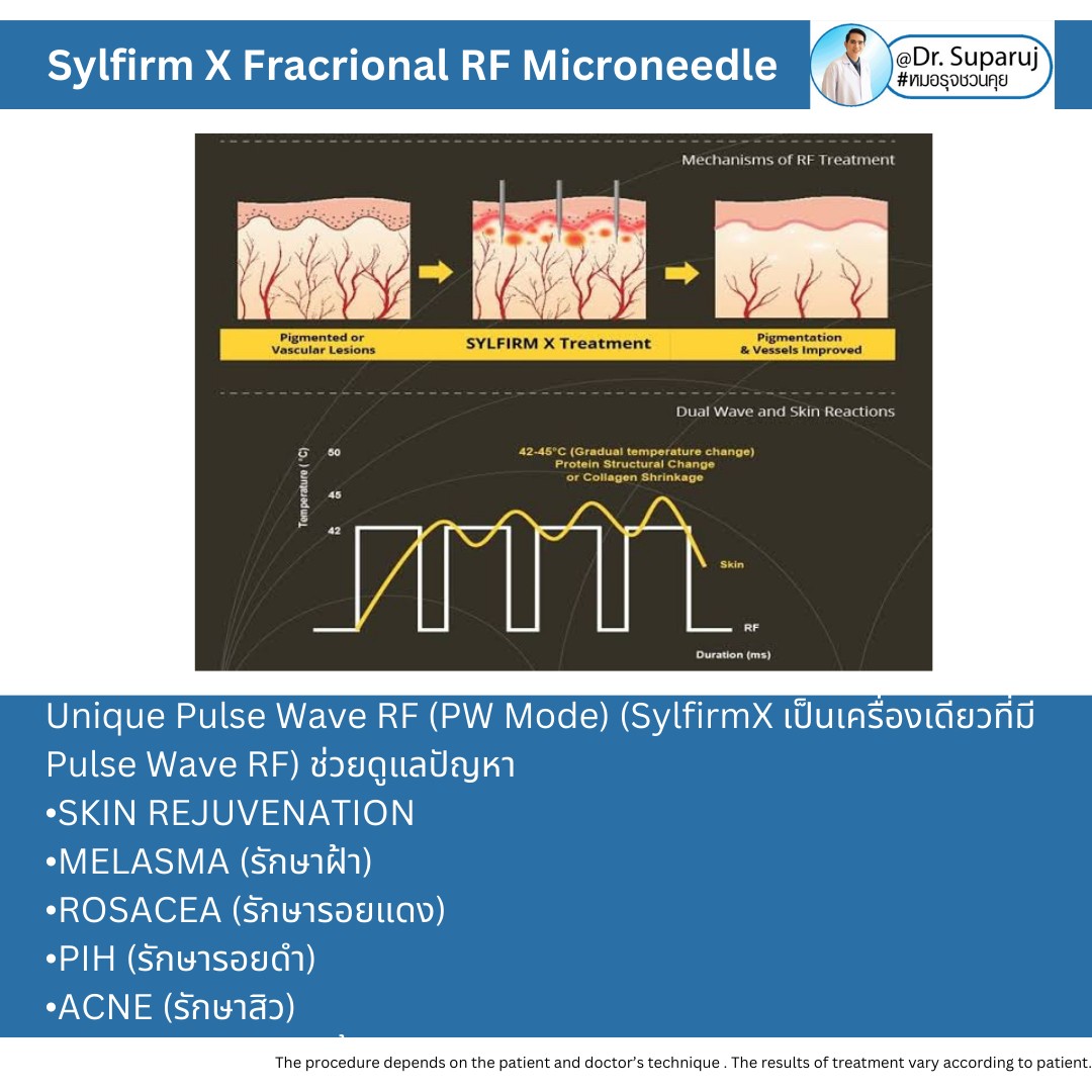 Update เทคนิคยกกระชับผิว หลุมสิว ดูแลปัญหาเม็ดสี ฝ้า+เส้นเลือด ด้วยนวัตกรรมคลื่นวิทยุแบบเข็ม Fractional microneedle Radiofrequency : SYLFIRM X