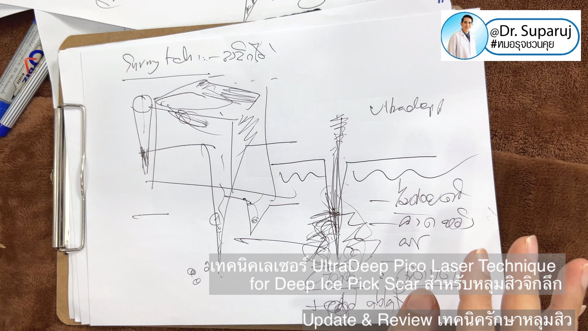 Update & Review เทคนิครักษาหลุมสิว (Acne Scar Treatment: Update & Review) Update & Review เทคนิครักษาหลุมสิว (Acne Scar Treatment: Update & Review)