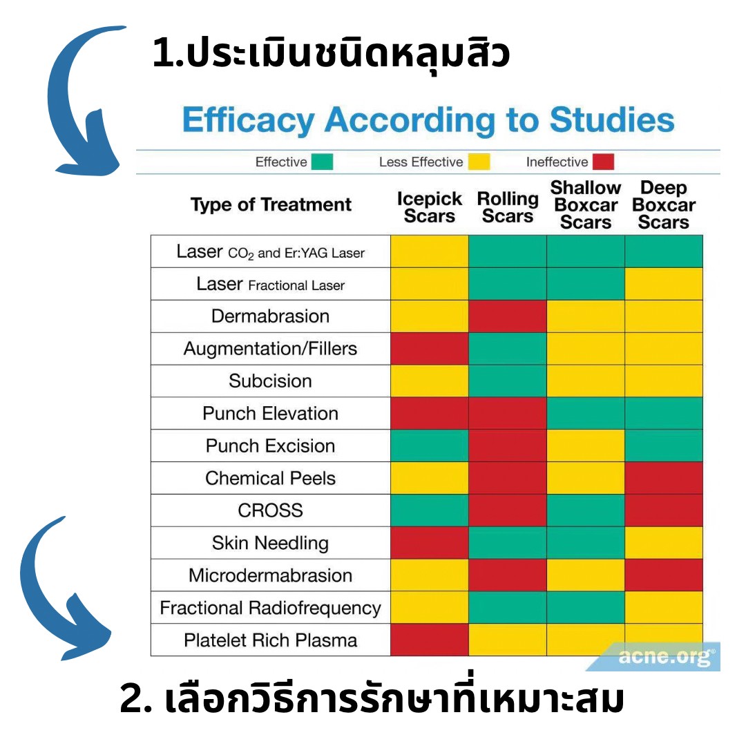 เป็นหลุมสิว แต่ยังไม่พร้อมรักษาหลุมสิว ทำอย่างไรดี? (+ เทคนิคการ เลือกใช้วิธีรักษาลุมสิวเบื้องต้นครับ)