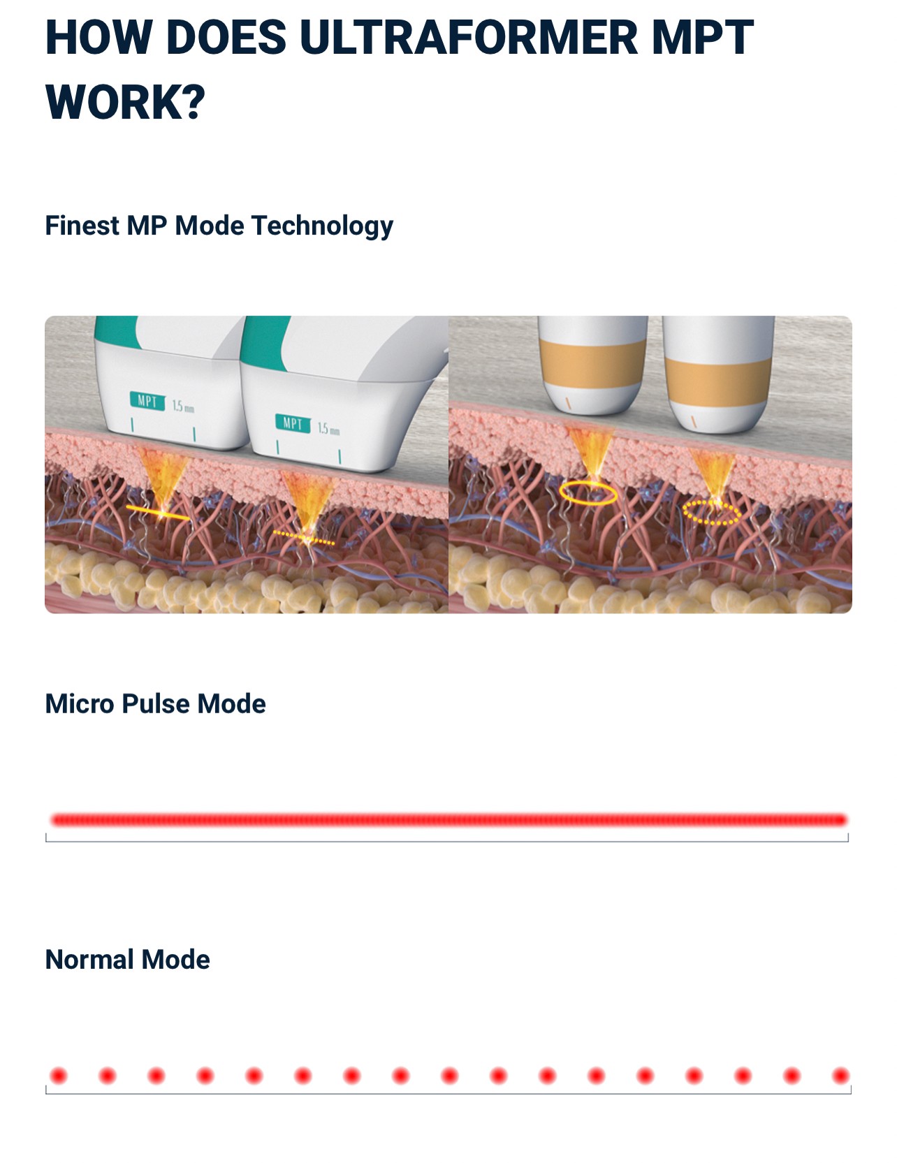 แนะนำนวัตกรรมยกกระชับผิวด้วยพลังงานคลื่นเสียง Hyperthermia Lifting Therapy: Ultraformer MPT Micro-Pulse Technology แนะนำนวัตกรรมยกกระชับผิวด้วยพลังงานคลื่นเสียง Hyperthermia Lifting Therapy: Ultraformer MPT Micro-Pulse Technology