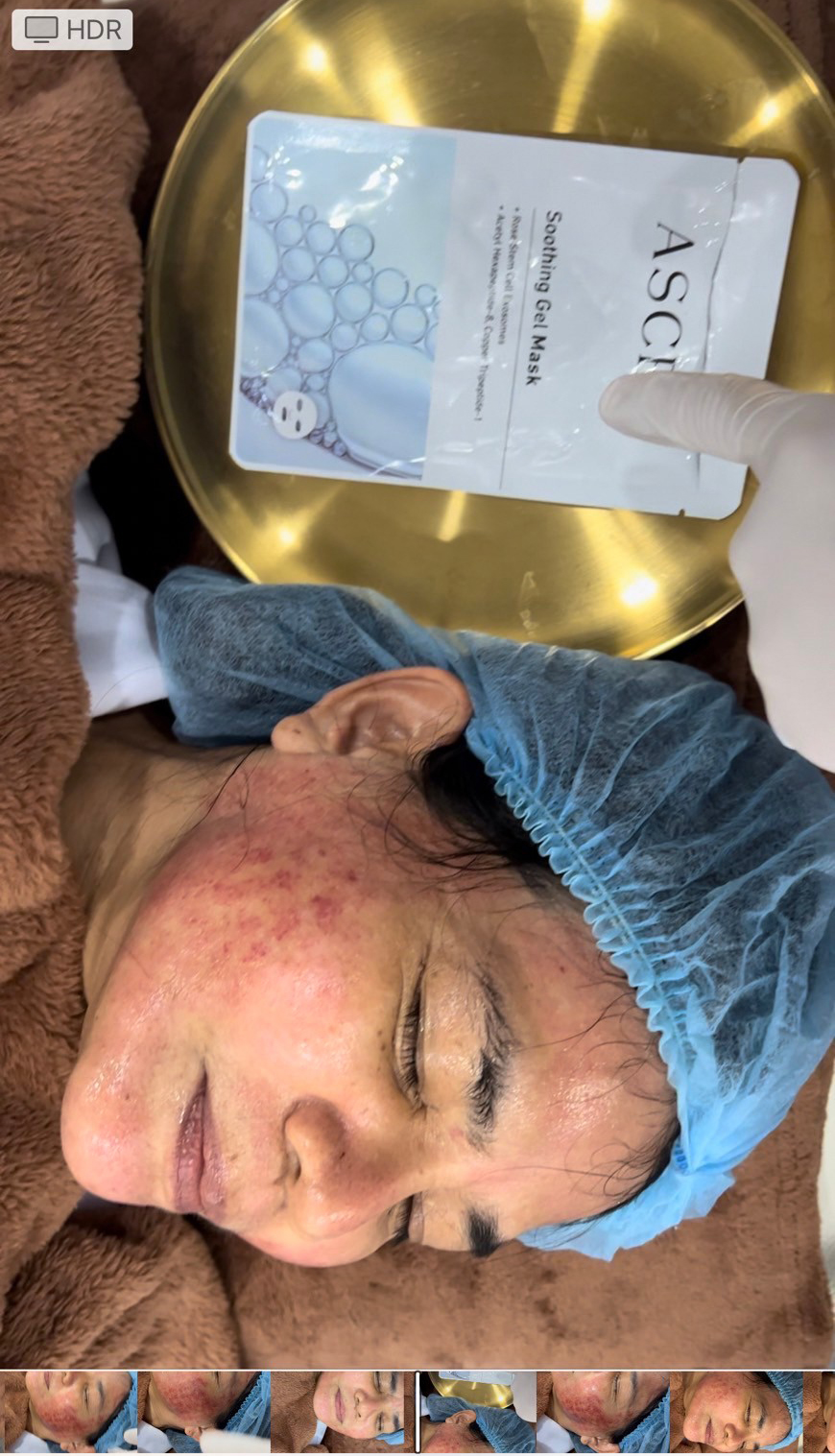 เทคนิคดูแลผิวลดรอยแดงหลังการรักษาหลุมสิว Discovery Pico Laser ด้วย ASCE + Soothing Gel Mask: ช่วยลดรอยแดงได้จริงไหม ? (ท้ายคลิปมีตัวอย่างผลการรักษาครับ) เทคนิคดูแลผิวลดรอยแดงหลังการรักษาหลุมสิว Discovery Pico Laser ด้วย ASCE + Soothing Gel Mask: ช่วยลดรอยแดงได้จริงไหม ? (ท้ายคลิปมีตัวอย่างผลการรักษาครับ)