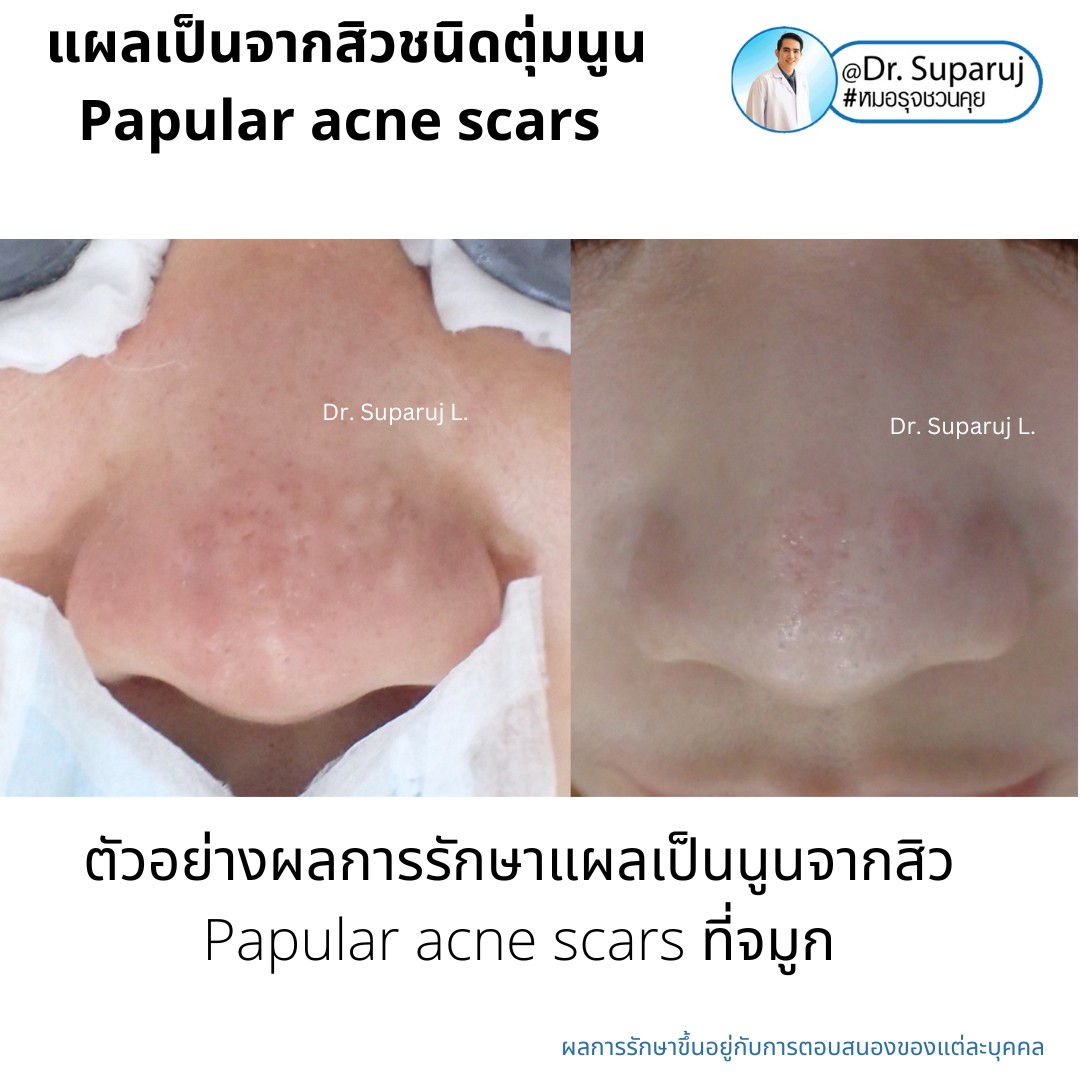 เทคนิคดูแลแผลเป็นตุ่มนูนจากสิว Papular acne scar ที่จมูก + คาง ด้วย Fractional Discovery Picosecond Laser + Deep Focused Ablative Laser