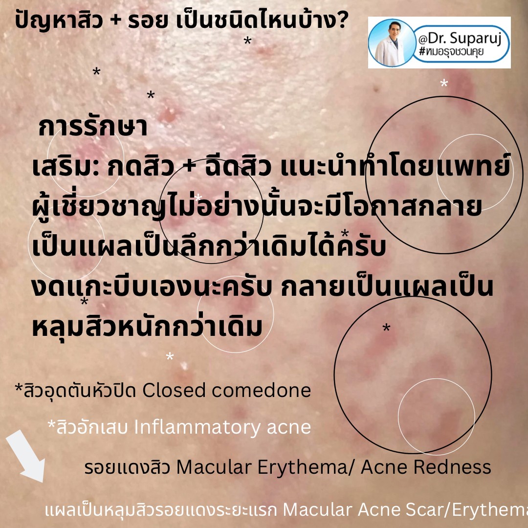 ปัญหาสิว + รอย เป็นชนิดไหนบ้าง? ปัญหาสิว + รอย เป็นชนิดไหนบ้าง?