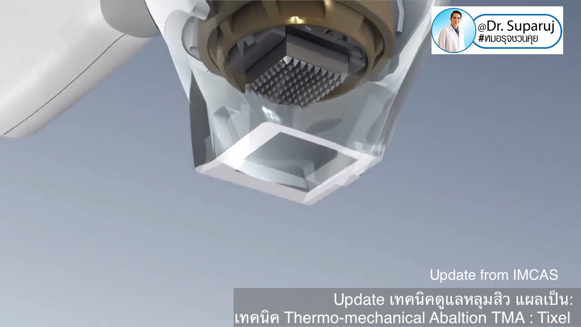 Update from IMCAS เทคนิครักษาหลุมสิว แผลเป็น ริ้วรอย: Tixel เทคนิค Thermo-mechanical Abaltion TMA